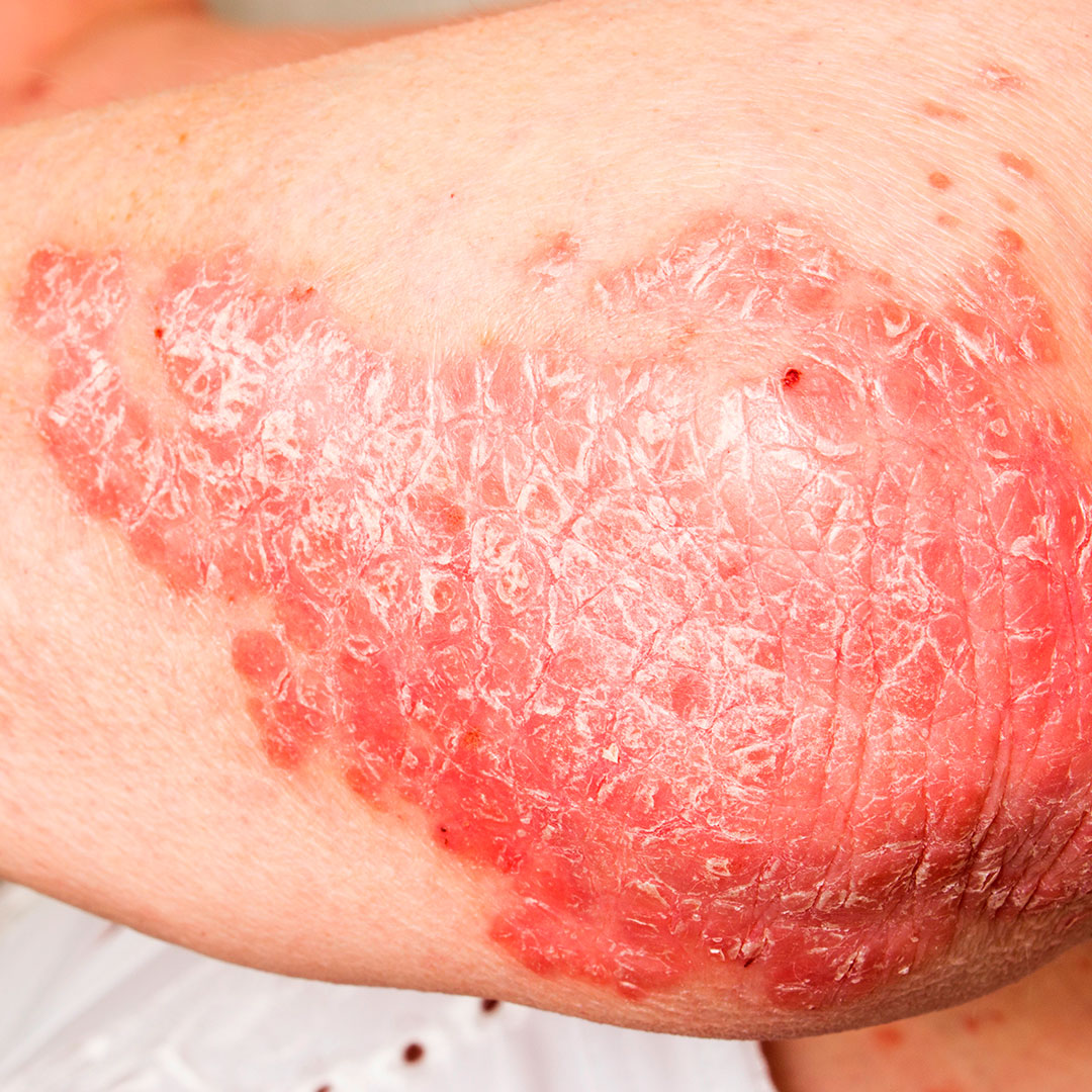 psoriasis